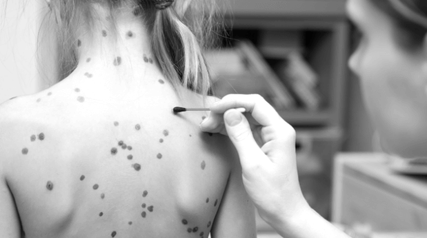 Léčba kožních onemocnění