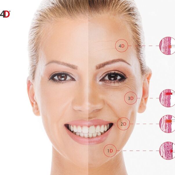 Jak zákrok probíhá?