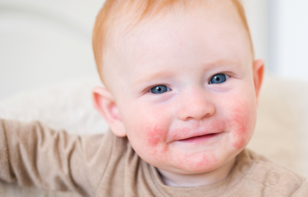 Periorální dermatitida