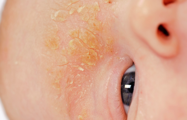 Seboroická dermatitida