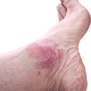 Lupénka kloubů / Psoriatická artritida (Psoriasis arthropatica)