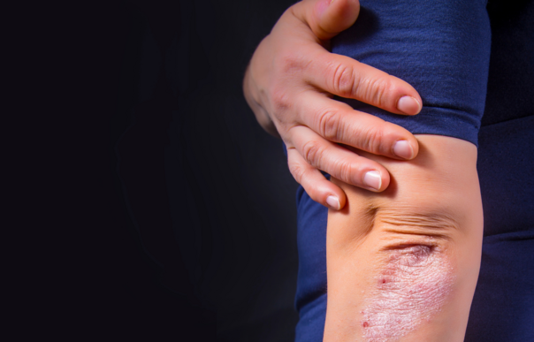 Lupénku nelze zcela vyléčit, ale …