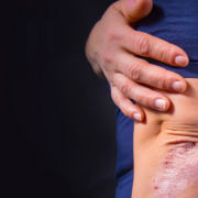 Pustulozní lupénka