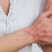Ložisková lupénka (Psoriasis vulgaris)