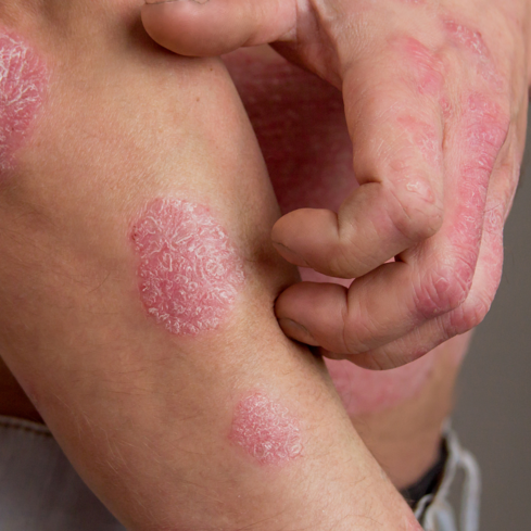 Lupénka na rukou a loktech