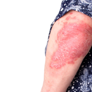Inverzní lupénka (Psoriasis inversa)