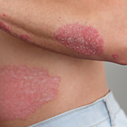 Kapkovitá lupénka (Psoriasis guttata)