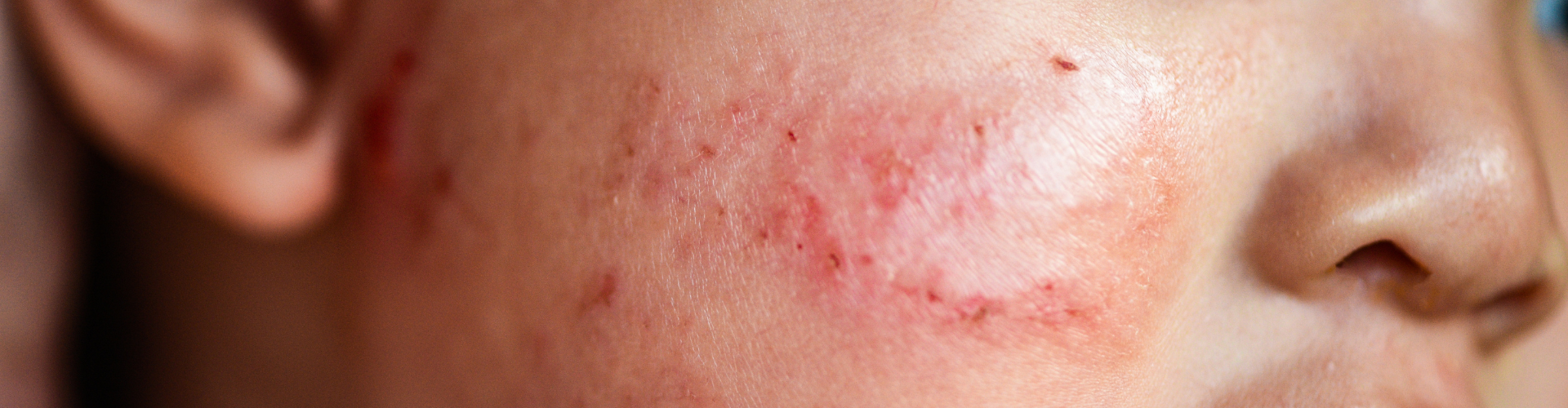 Pomůžeme vám s ekzémem