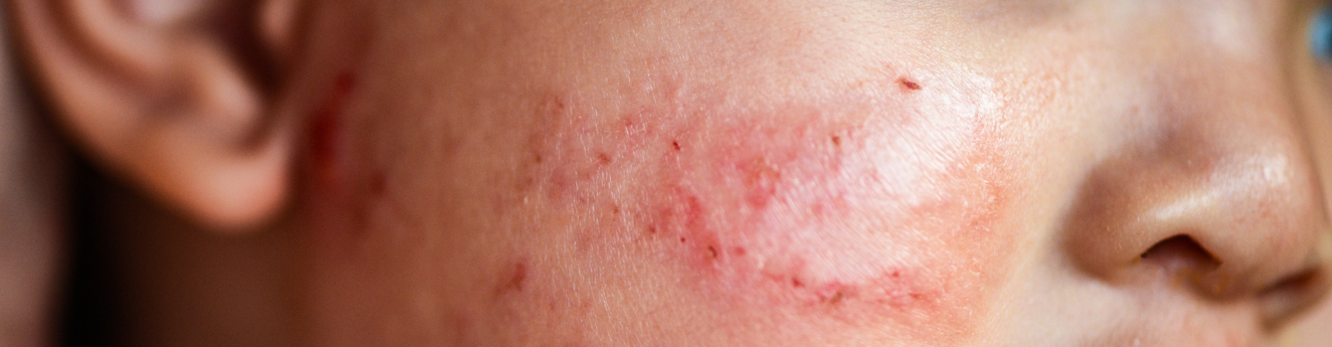 Pomůžeme vám s ekzémem